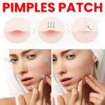 Star Color Acne Patch To Reduce Acne Spots-200PCS - Image 4